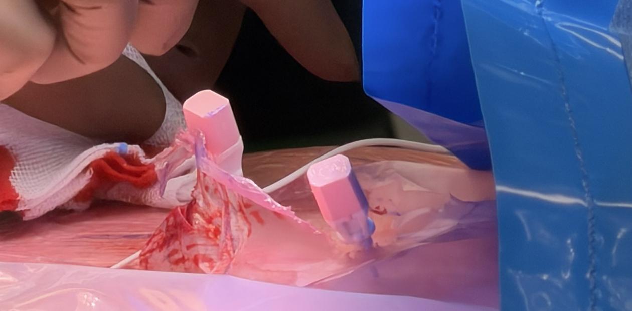 sacrale neuromodulatie